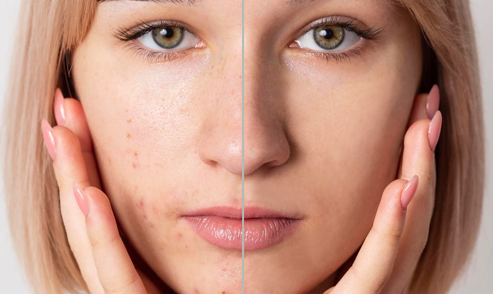 trattamenti per l'acne