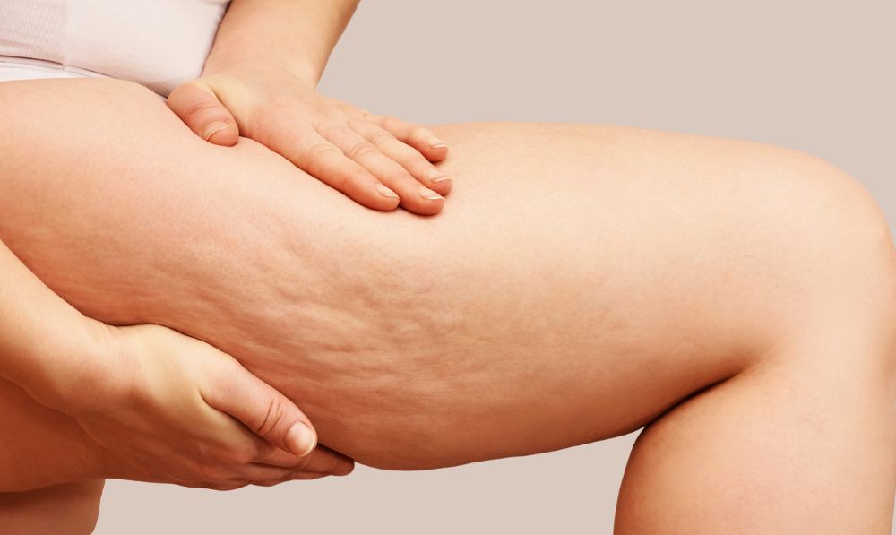 inestetismi cellulite