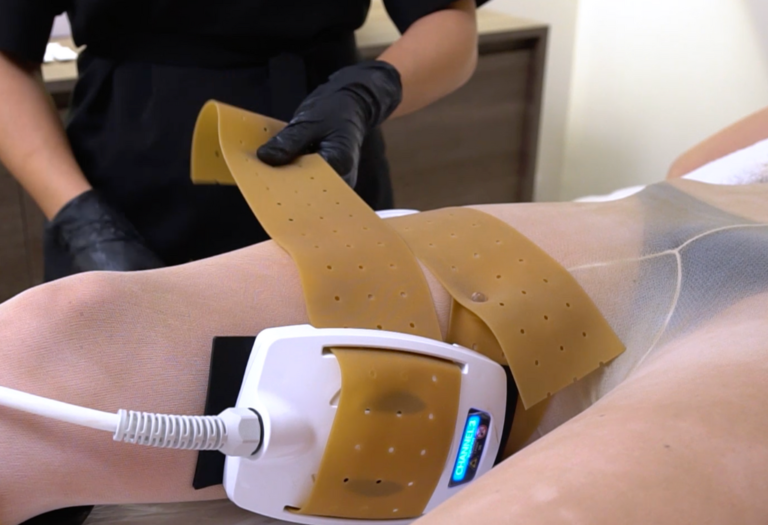 Il lipolaser funziona? Scopri che cos'è e perchè fare il trattamento